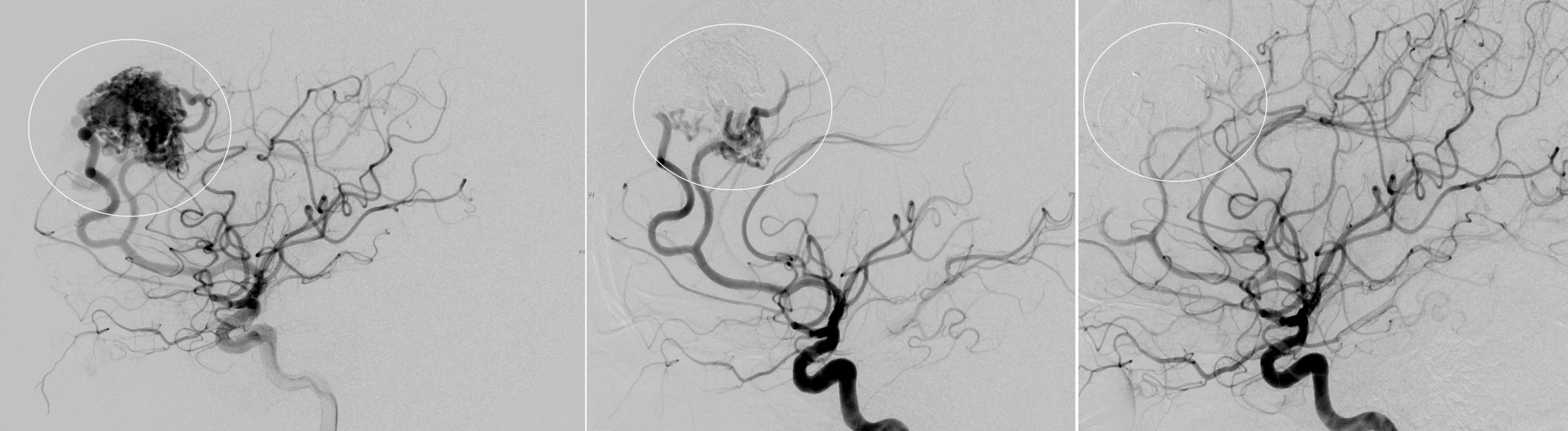 Angiographische Darstellung einer AVM
