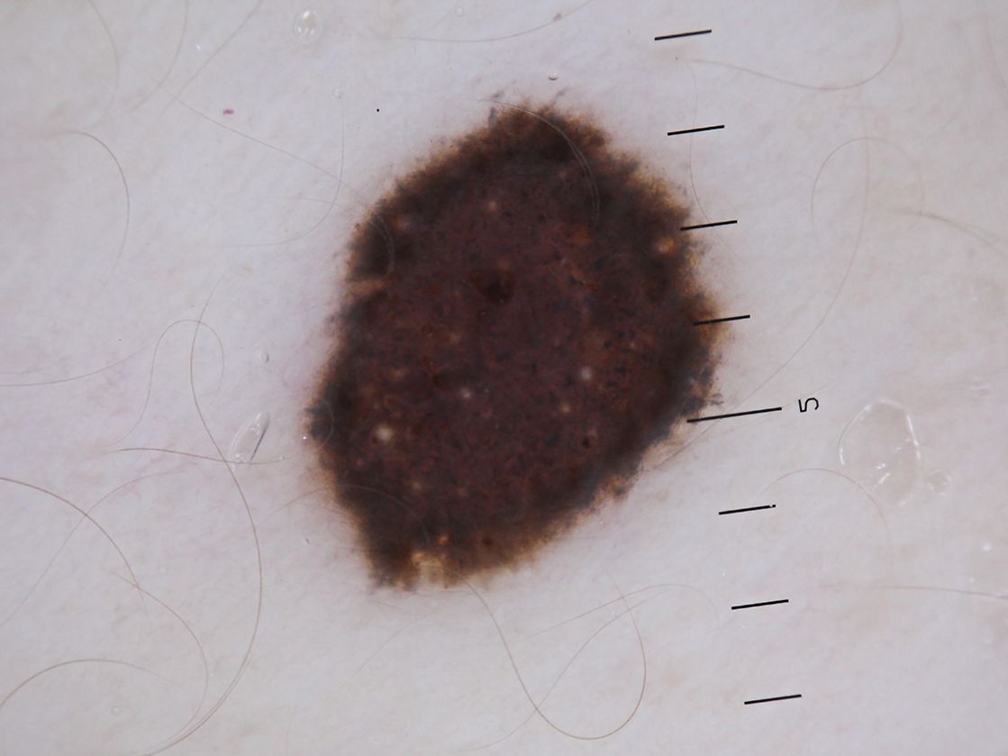 Dermatoskop-Foto eines Melanoms