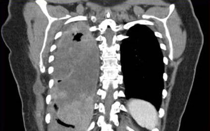 MRI NUT carcinoma