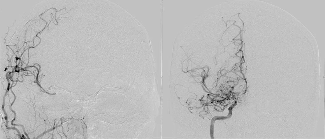 Angiographie zur Darstellung der zusätzlichen Blutversorgung des Gehirns