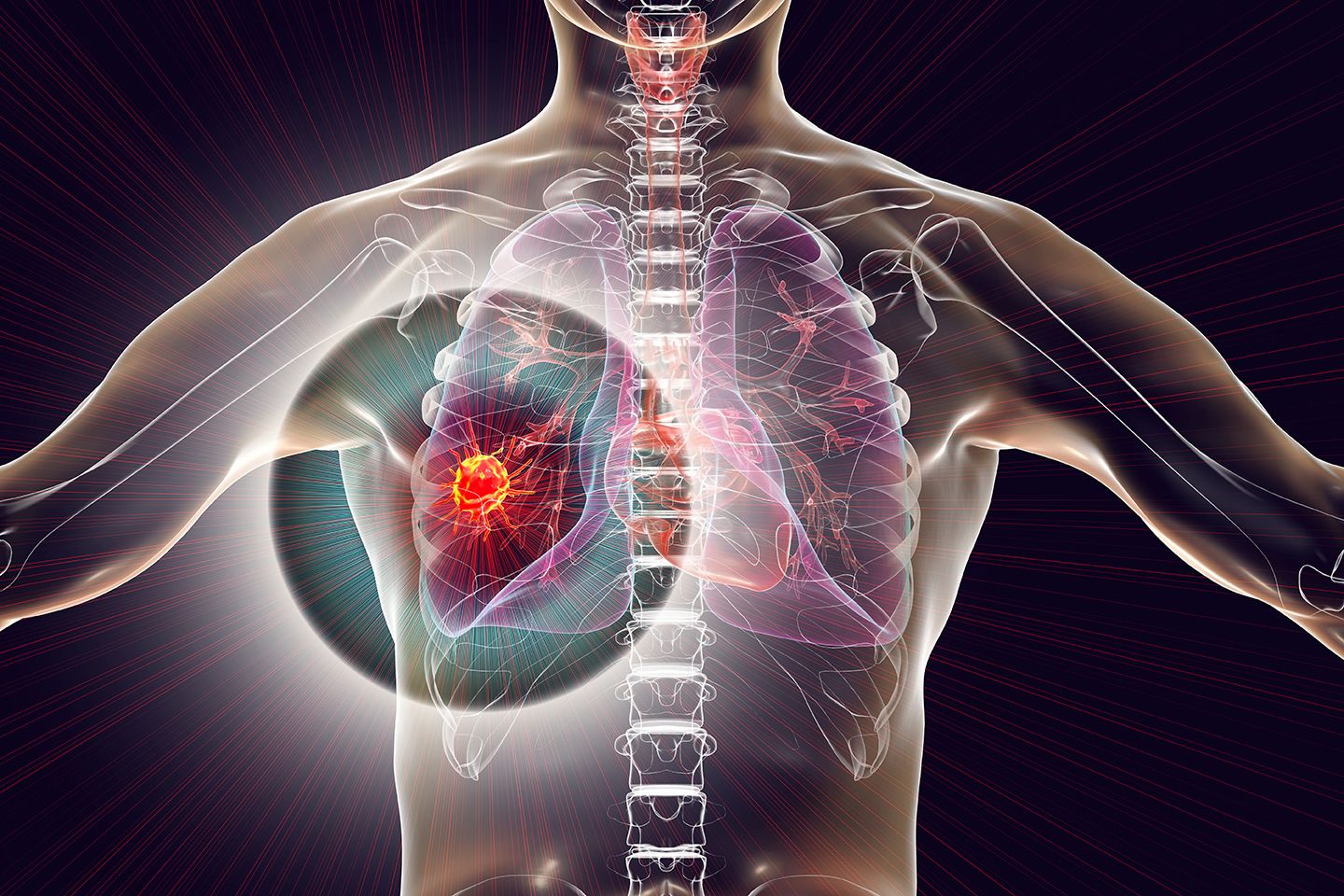 Lung cancer, 3D illustration