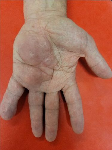 Neurofibrom der rechten Hyothenar- und Kleinfingerregion