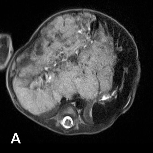 Wissenschaftliche Abbildung Leberhämangiom