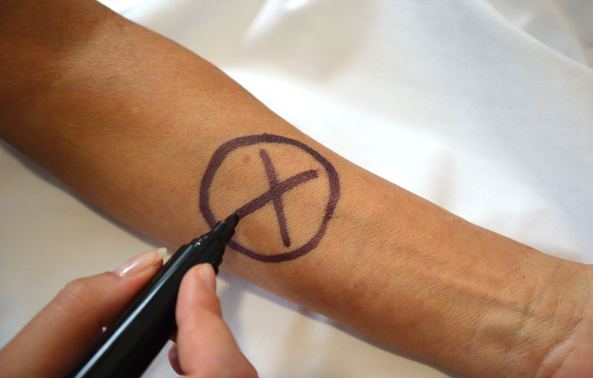 Mit einem Stift wird die zu operierende Stelle markiert.