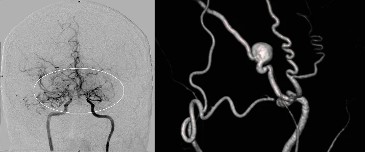 Angiographie beidseitige Moyamoya Krankheit