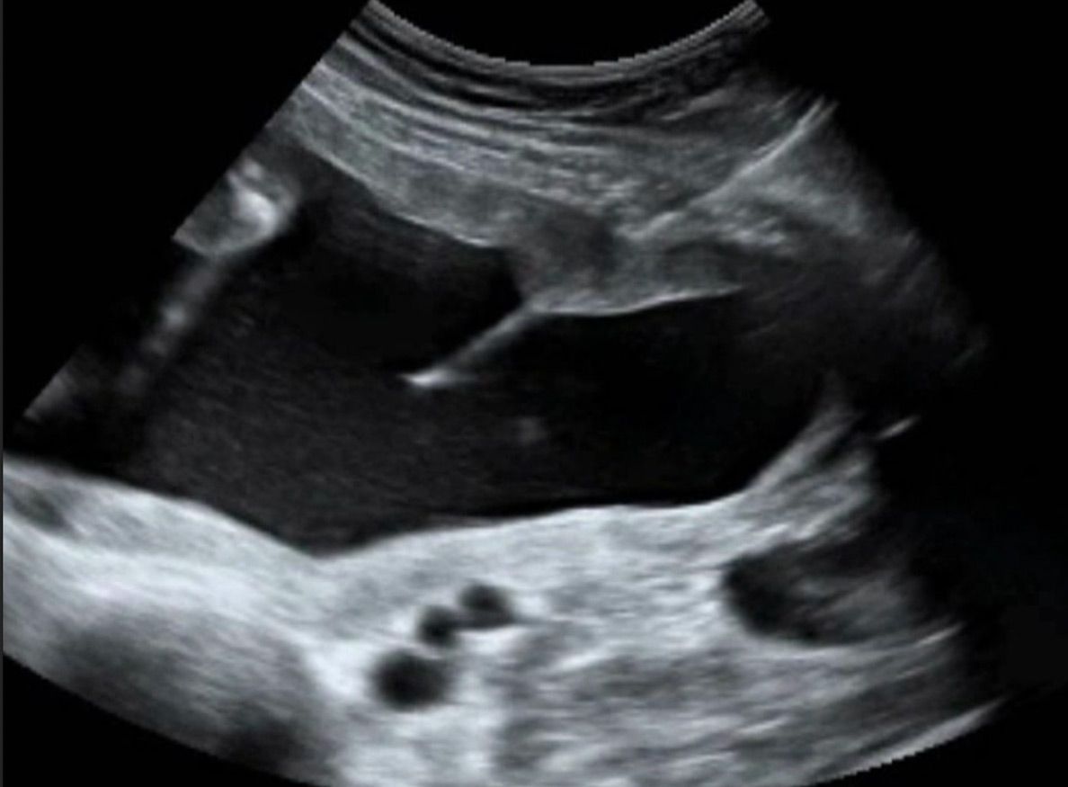 Fruchtwasserpunktion