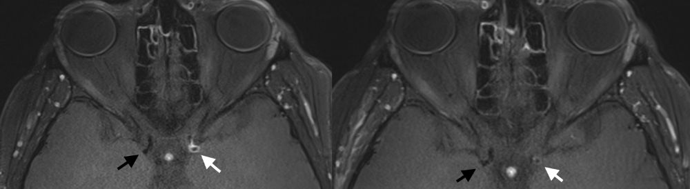 MRT Aufnahme Gefäßwand der Halsschlagader