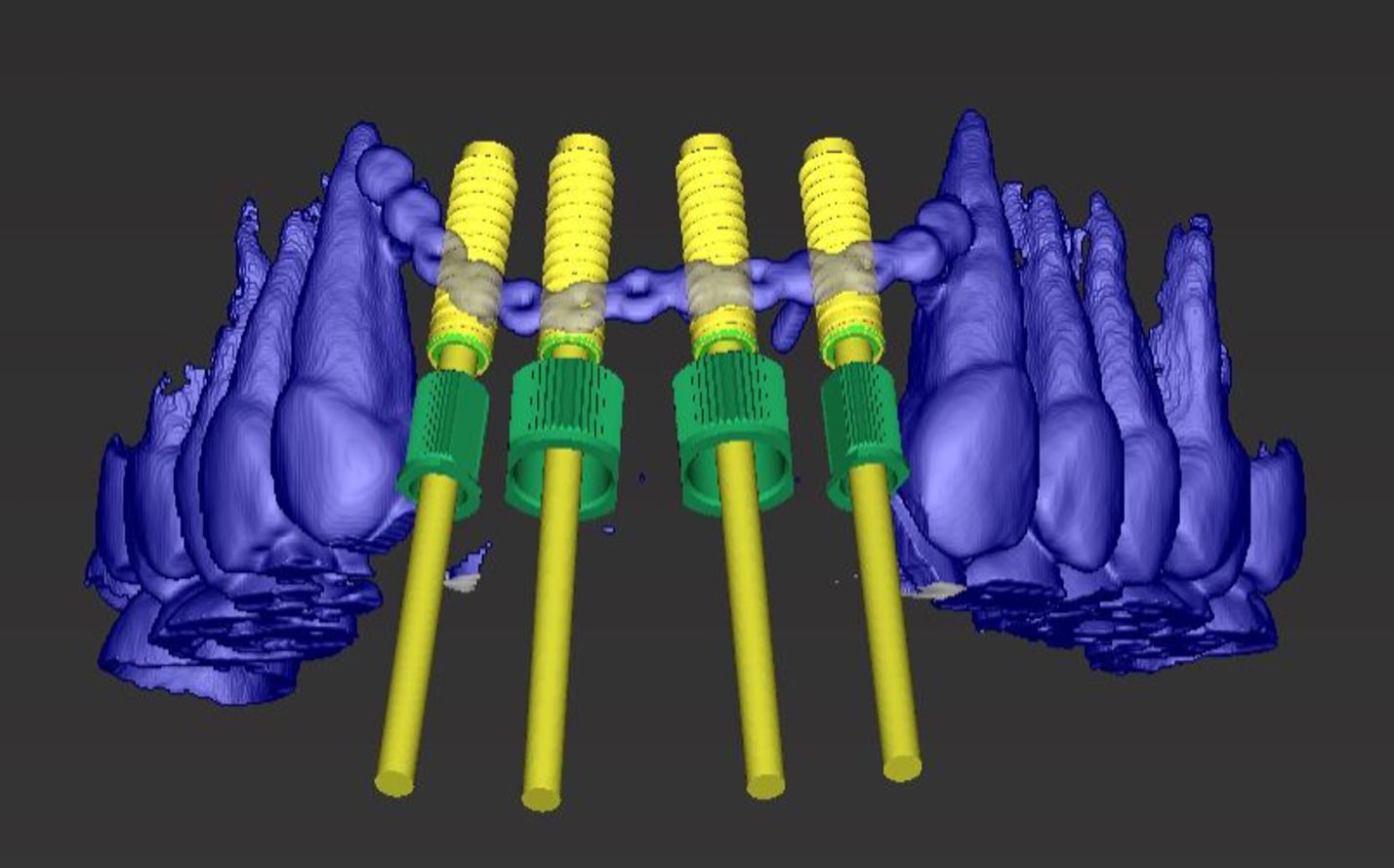 Computerdarstellung der Impantante im Kiefer