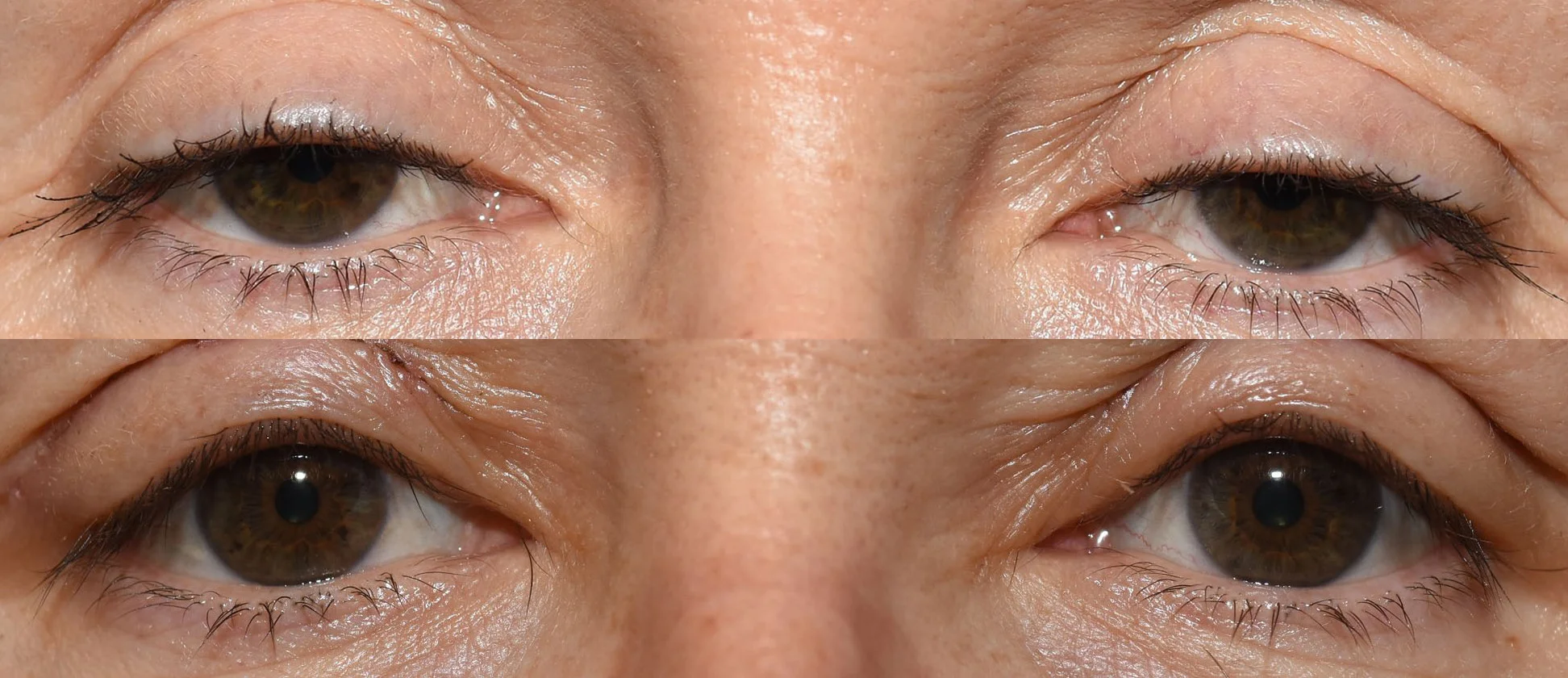 Vor und nach operativer Korrektur eines hängenden Oberlides (Ptosis) mit Einschränkung der Sehachse