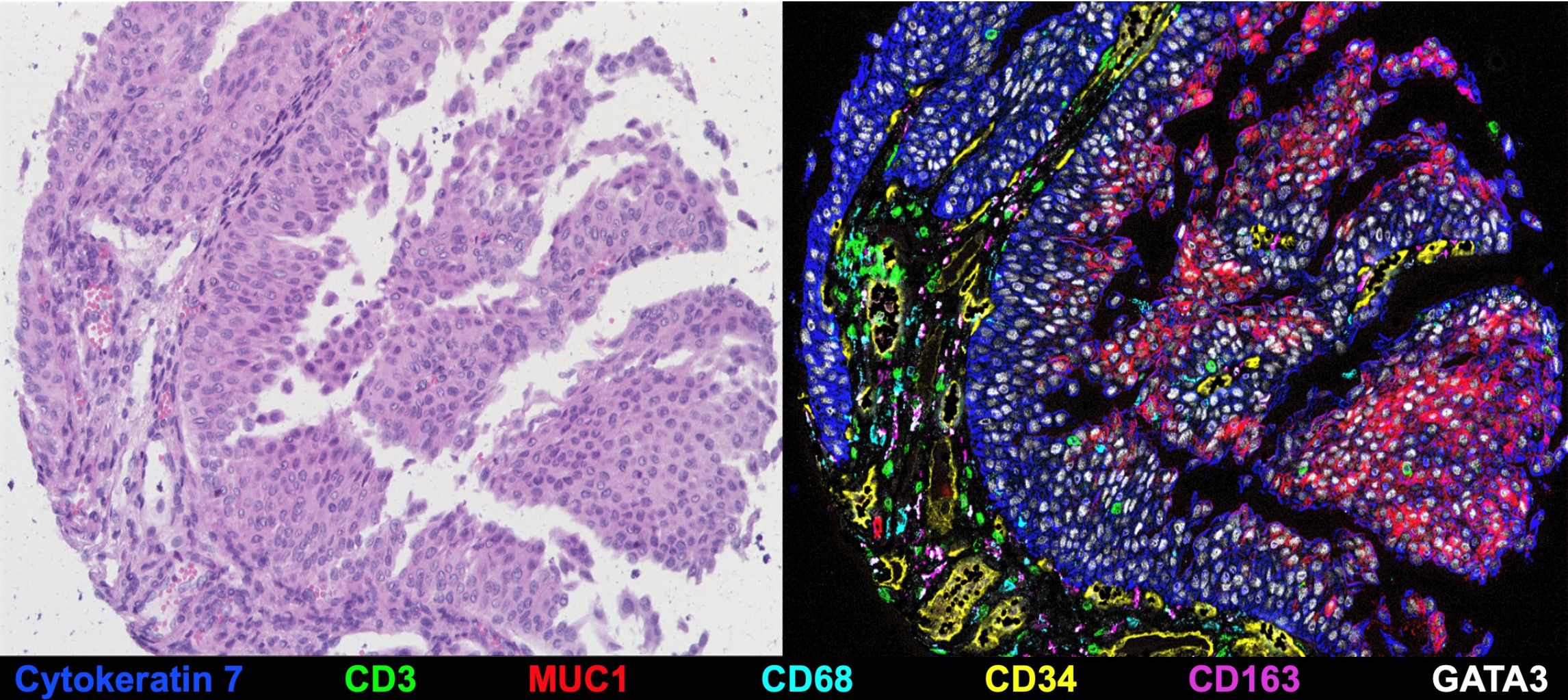 Links: H&E von UBC, rechts: 7-Plex-Overlay-Bild mit den angegebenen Markern. Die anderen 49 Marker sind nicht abgebildet.