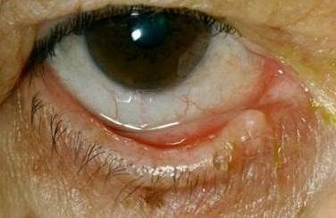 Auswärts gekipptes Unterlid mit Augentränen