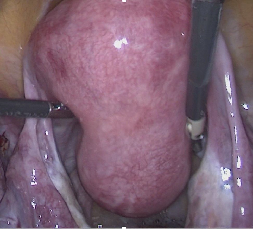 Abb.6: Sicht ein Myom der Gebärmutterhinterwand per Bauchspiegelung (Laparoskopie)