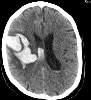 Bild einer intracerebralen Blutung nach OP.