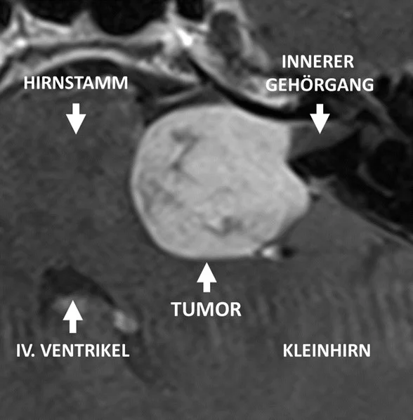 Magnetresonanzbildgebung mit der Beziehung des Tumors mit der Umgebung