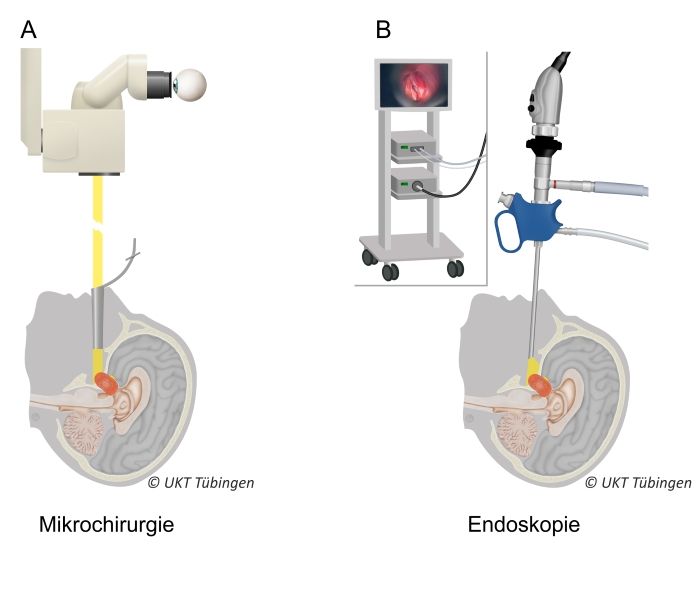 Schematische Darstellung der beiden OP-Techniken, siehe Bildunterschrift