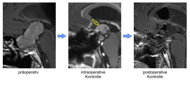 Großes Hypophysenadenom. Links: Präoperative Kernspintomographie. Mitte: Durch Verwendung der intraoperativen kernspintomographischen Kontrolle kann ein intrakranieller Tumor-Rest (gelber Pfeil) nachgewiesen und daraufhin noch während derselben Operation entfernt werden. Rechts: Die postoperative Kernspintomographie bestätigt die Entfernung des Resttumors.