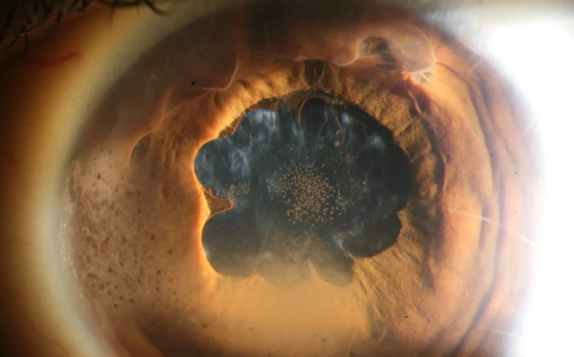 Krankes Auge