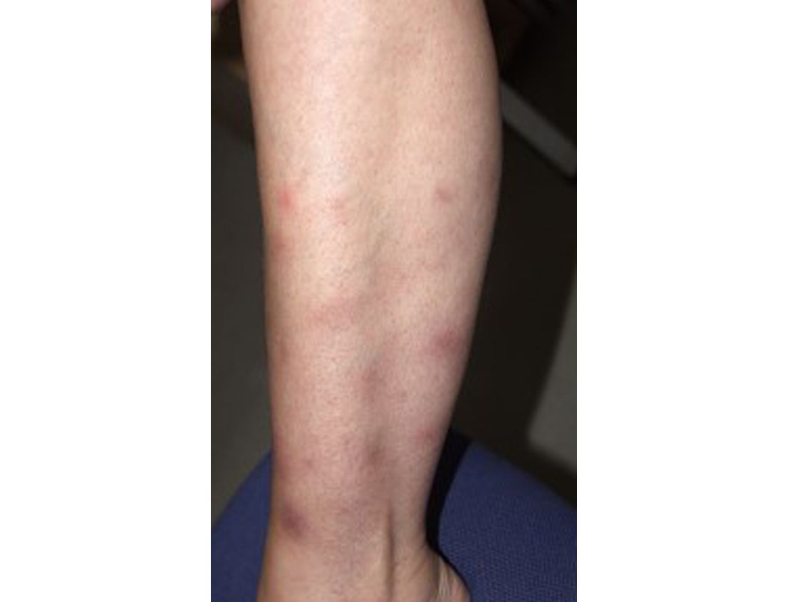 Aufnahme eines Unterschenkels mit roten Hautflecken