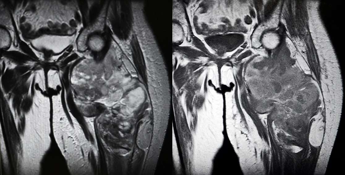 Sarkom der Oberschenkel, MRI
