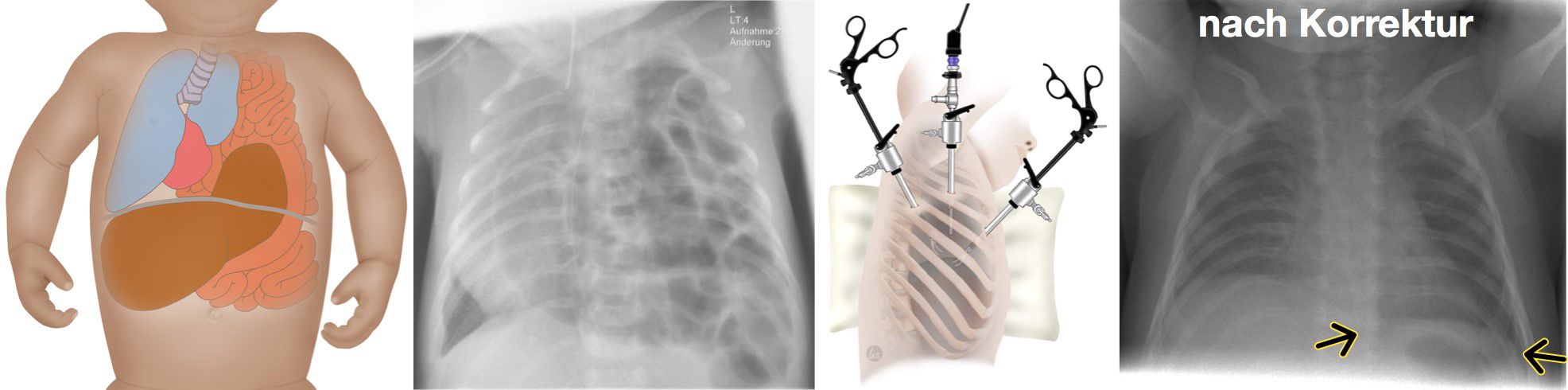 Zwerchfellhernie: Abb. links nach Korrektur.