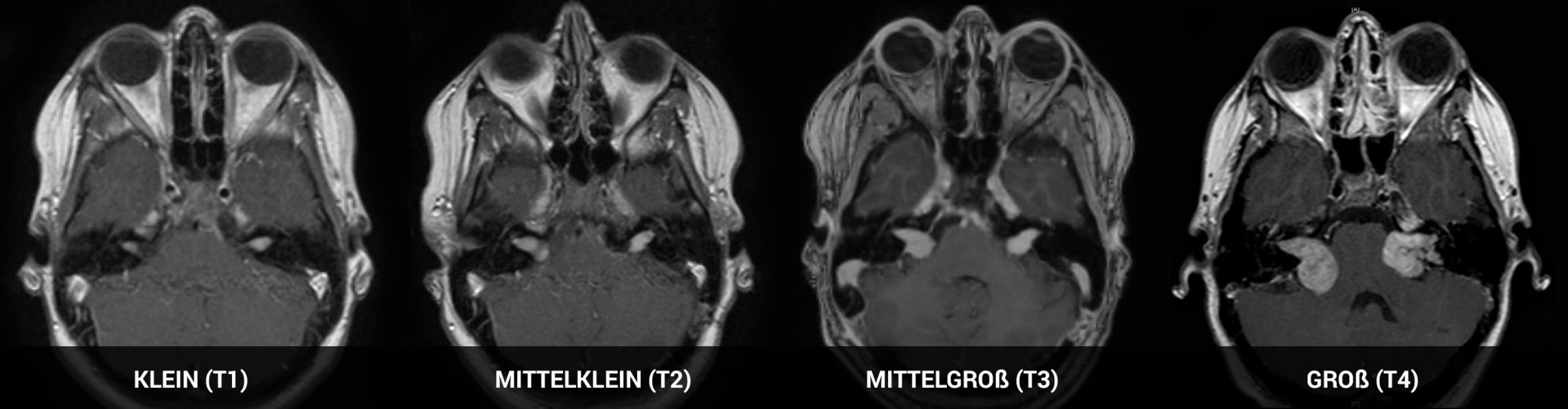Größeneinteilung bei beidseitigen Vestibularisschwannomen anhand der Hannover-Klassifikation
