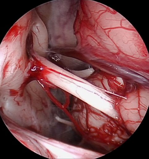 Blick in den Kleinhirnbrückenwinkel mit dem HD Endoskop