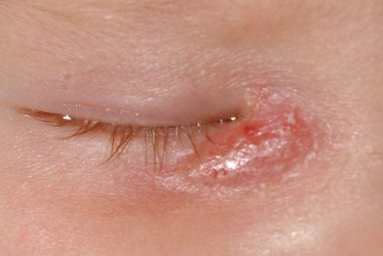 Akute Entzündung des Tränensacks