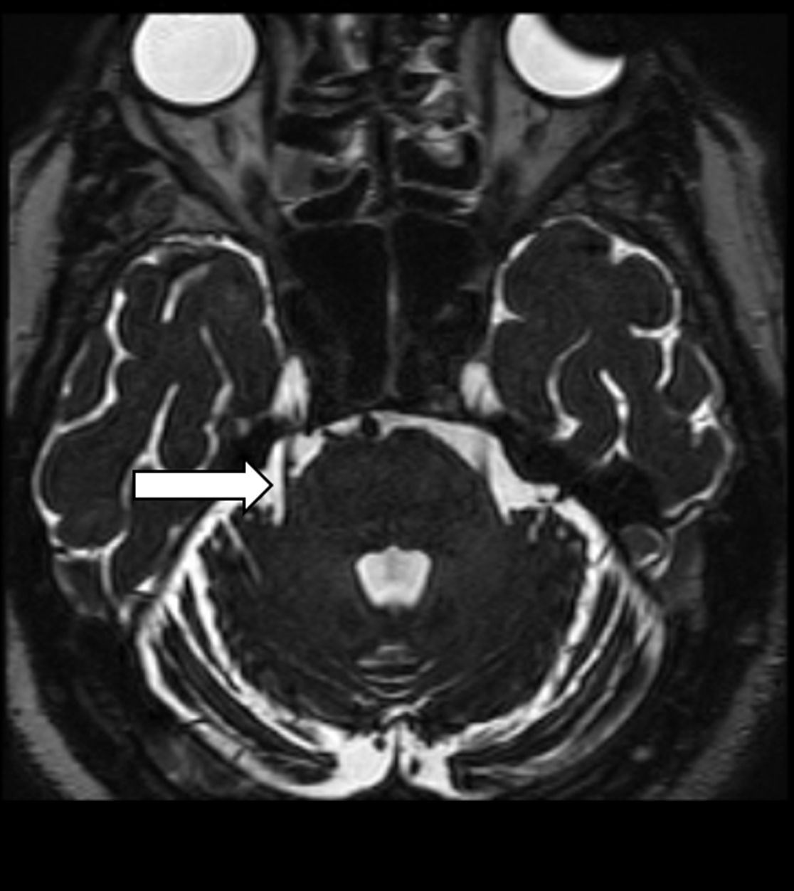 Gefäß-Nerven-Kontakt im Bereich des Nervus trigeminus (Pfeil)