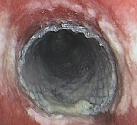 Bronchien