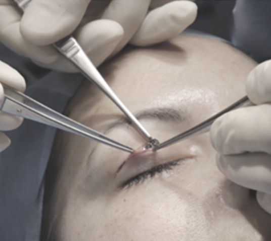 Abbildung Lidoperation