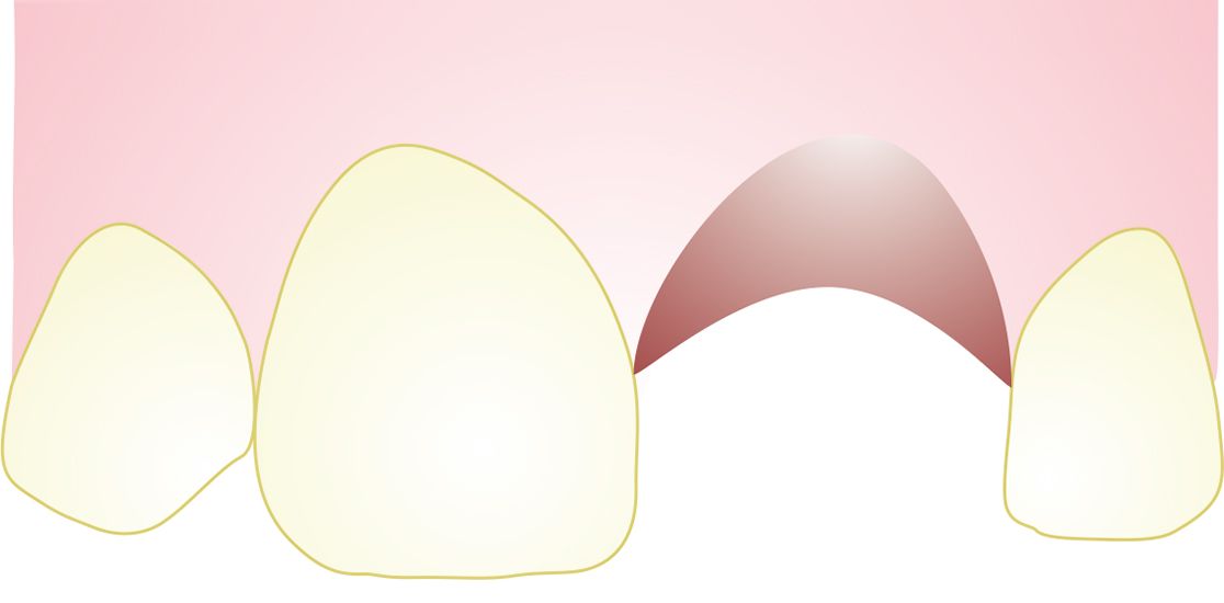 Drawing of a knocked out tooth