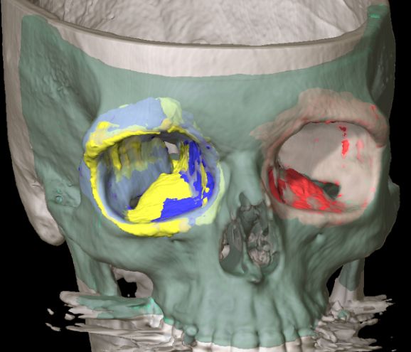 Computerdarstellung des Schädels mit bunt markierten Flächen