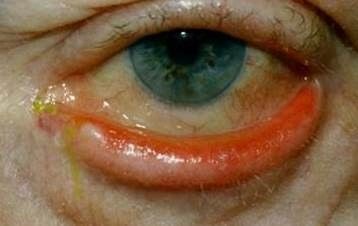 Auswärts gekipptes Unterlid mit chronischer Rötung und Entzündung