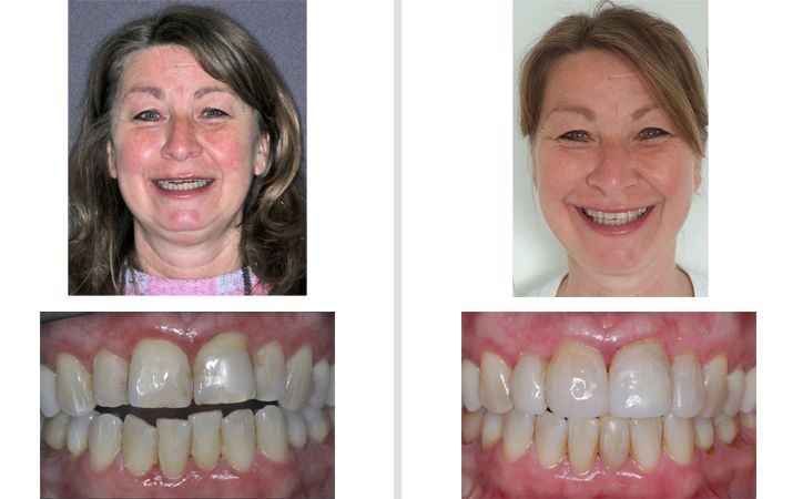 Abbildungen der Zahnbehandlung Links vorher: Lücke zwischen Zähnen Ober und UNterkiefer, rechts nachher: Die Lücke ist geschlossen.