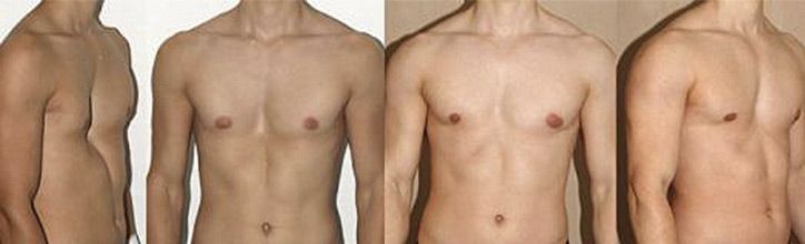 Kielbrust Pectus excavatum: