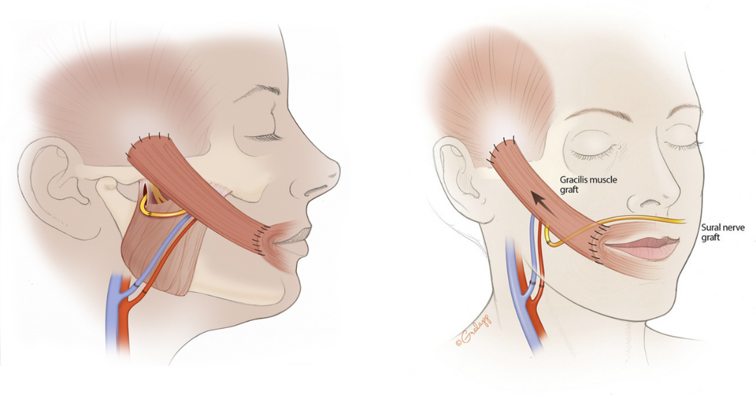 Abbildung 5: Freies Muskeltransplantat des M. Gracilis mit neuer Gefäßversorgung (A. und V. facialis) und Nervenkoaptation zum N. Massetericus (rechts) oder einem Crossface-Nerve-Graft (links)