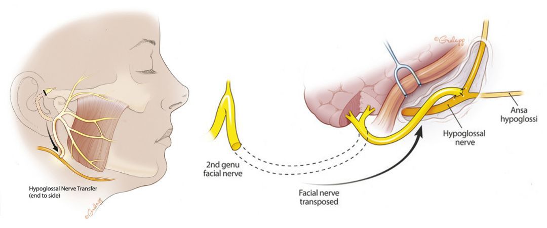 Transfer des Nervus facialis (VII) zum Nervus hypoglossus (XII) nach Mobilisation des proximalen Nerven aus dem Felsenbein  (End zu Seit). Links seitliche Ansicht, rechts intraoperative Ansicht
