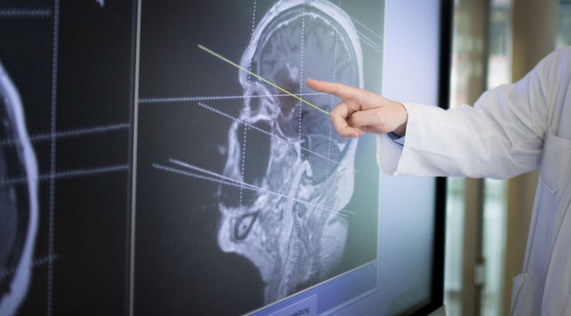 Symbolbild: Arzt zeigt auf CT vom Kopf