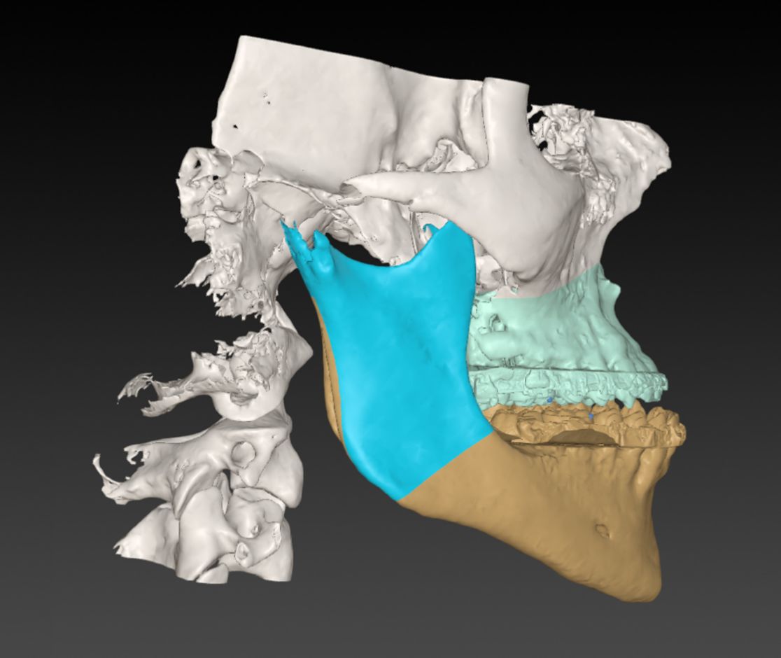 3D Darstellung eines Kiefers mit Dysgnathie