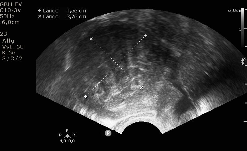 Abb. 2: Ultraschalldarstellung eines intramuralen Myoms (in der Gebärmuttermuskulatur) der Gebärmutterhinterwand