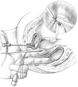 Abbildung einer laparoskopisch assistierte Anlage einer Neovagina