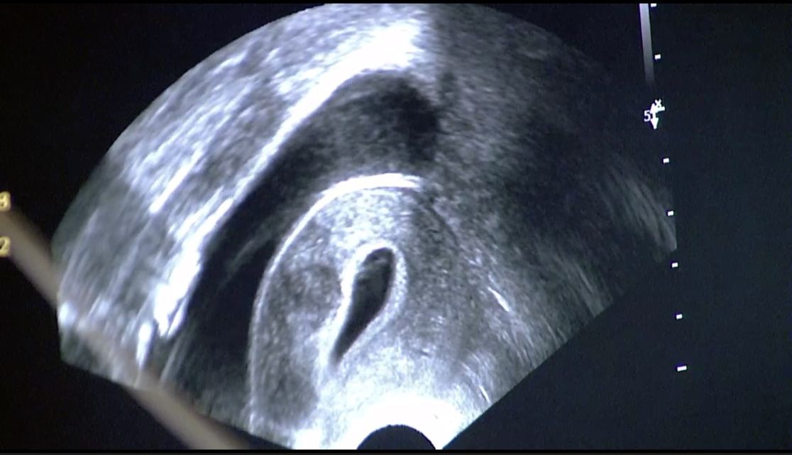 Abb. 5: intraoperative Ultraschalldarstellung eines intramuralen Myoms der Gebärmuttervorderwand (in der Gebärmuttermuskulatur) mit flüssigkeitsgefüllter Blase (links) und Gebärmutter (mitte)