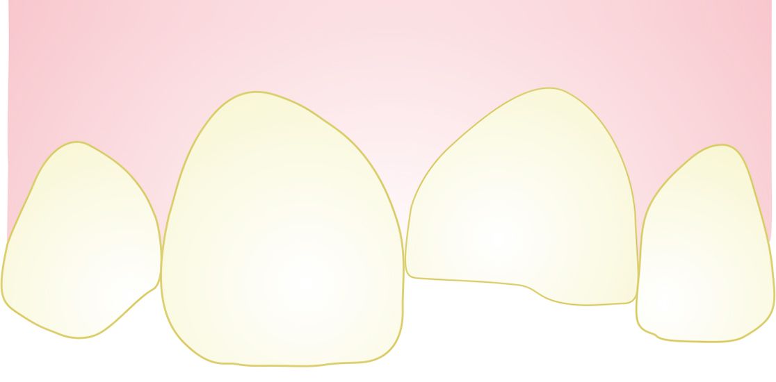 Zeichnung eines abgebrochenen Zahns