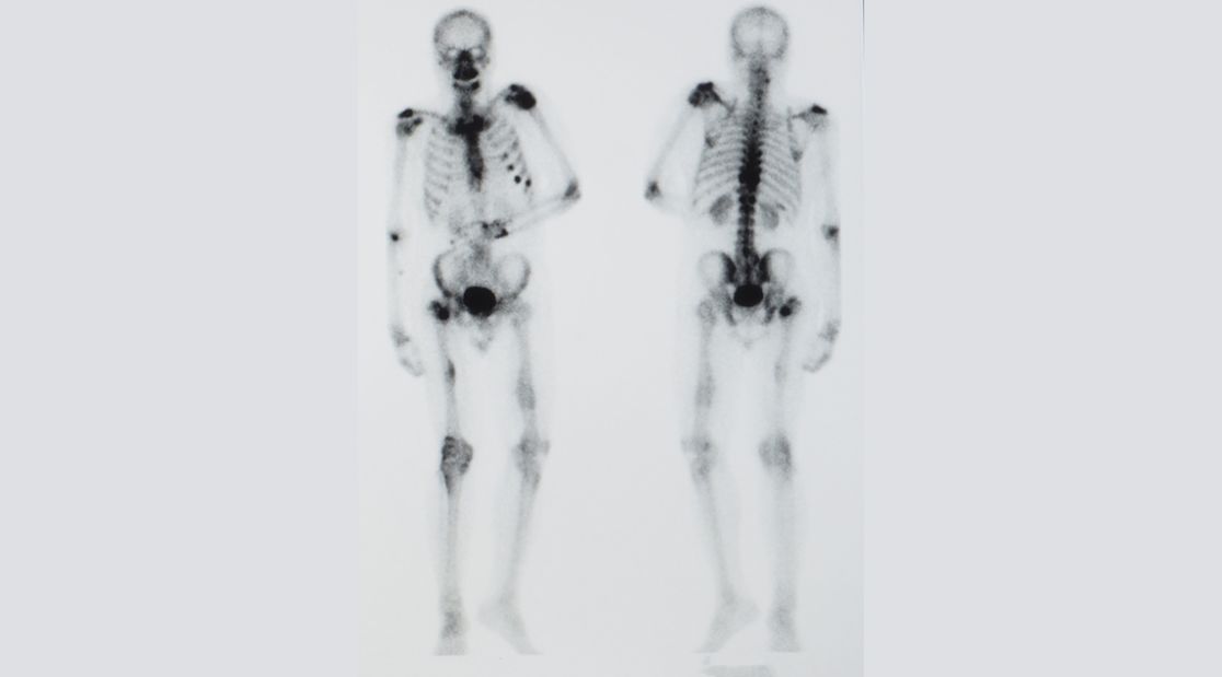 Röntgenbilder Solide Tumoren