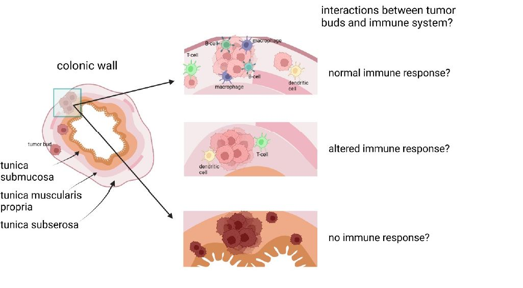 Schematische Darstellung: Interaktionen von Tumorknospen mit dem Gewebe-Mikromilieu des Tumors in der Dickdarmwand.