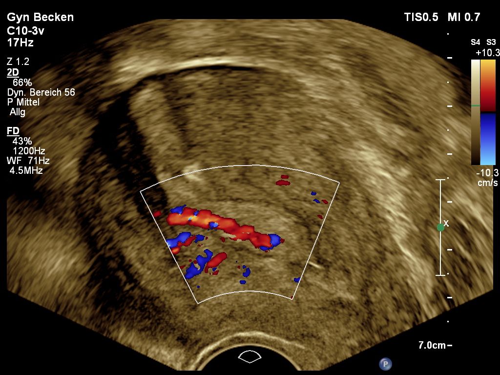 Gynäkologische Sonographie Universitätsklinikum Tübingen