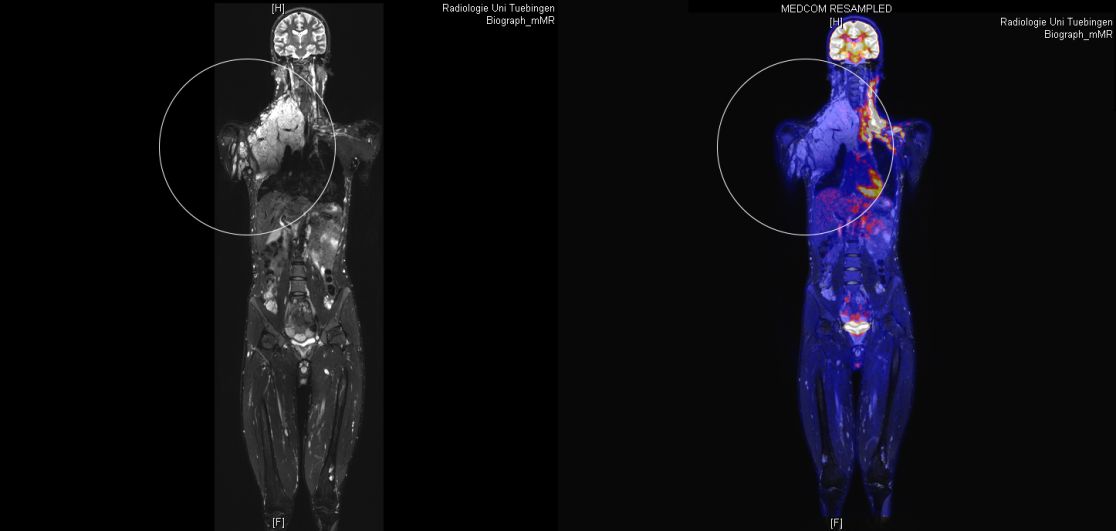 Beispiel: PET-MRT-Bildgebung bei einem Neurofibromatose Typ 1 Patient.