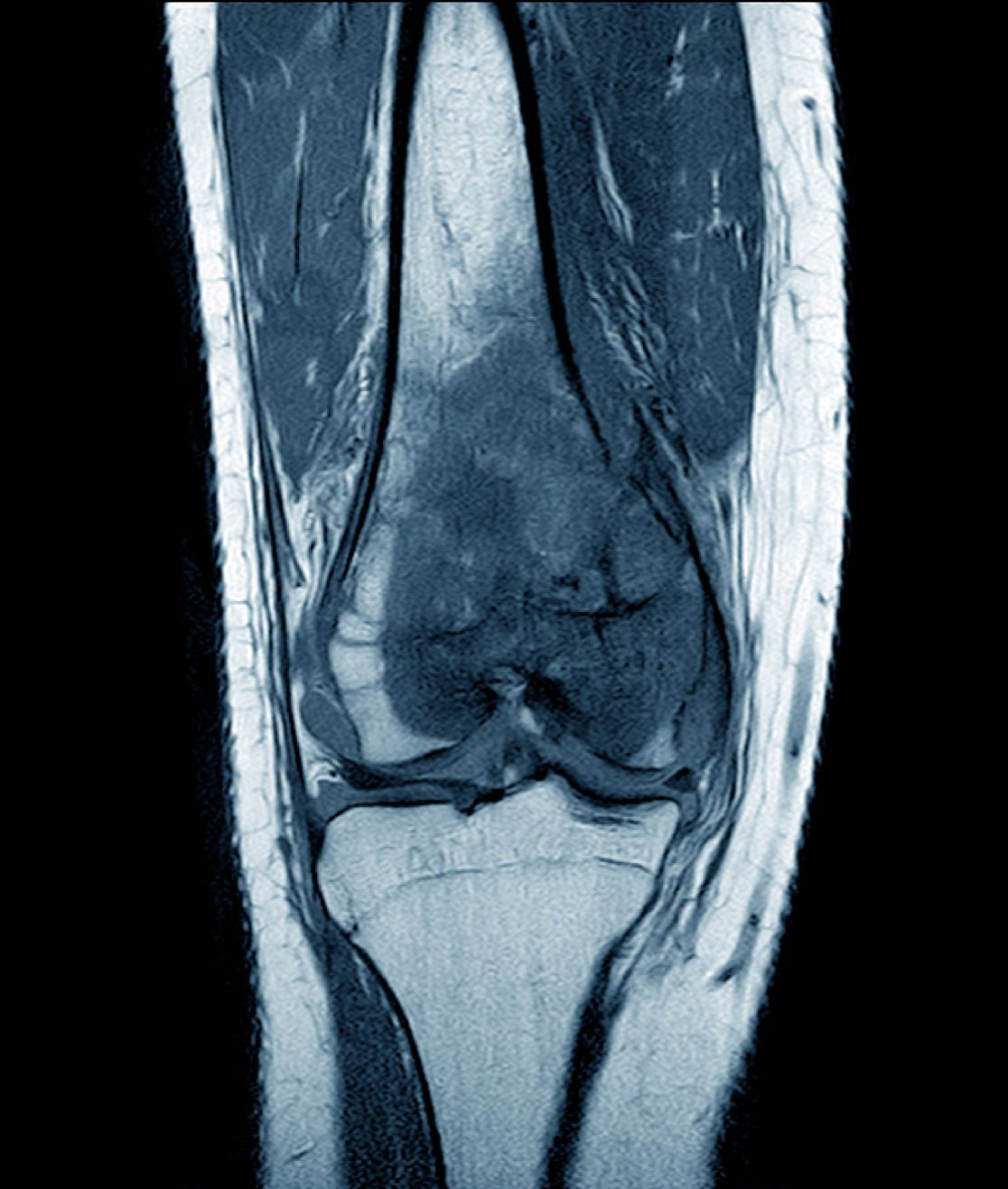 MRI image sarcoma knee