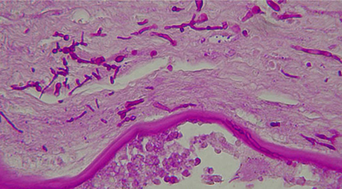 Pilzkeratitis