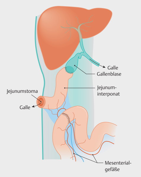 Wissenschaftliche Abbildung: Externe Gallengansdrainage mit Stoma zur Bauchdecke